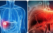 Người đàn ông 63 tuổi phát hiện ung thư gan thừa nhận 1 sai lầm nhiều người Việt mắc phải