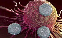 Người phụ nữ 58 tuổi phát hiện ung thư buồng trứng từ dấu hiệu nhiều chị em Việt bỏ qua