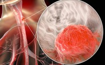 Người đàn ông 71 tuổi bất ngờ phát hiện ung thư thực quản giai đoạn sớm từ 1 việc nhiều người Việt bỏ qua