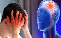 Người đàn ông 3 lần đột quỵ ở tuổi 40, bác sĩ phát hiện nguyên nhân