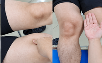 Đùi to bất thường nhưng không đau, người đàn ông 39 tuổi phát hiện ung thư mô mềm hiếm gặp
