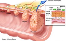 5 triệu chứng của ung thư đại tràng: Có thể bạn mắc mà không biết