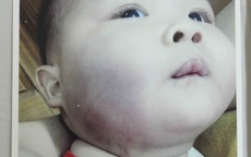 Bé 8 tháng tuổi nghi bị đánh ở nhà trẻ, sưng tím mặt mũi, tay chân