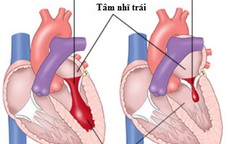 Phòng ngừa suy tim do hẹp, hở van tim