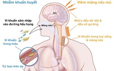 Dấu hiệu cảnh báo bệnh viêm não mô cầu