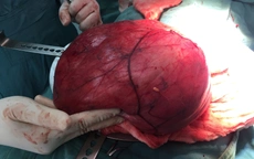 Phẫu thuật thành công khối u khổng lồ 6kg nằm trong ổ bụng bệnh nhân