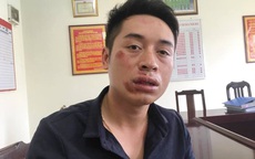 Hà Nội: Một chiến sĩ CSGT bị đấm gãy 2 răng cửa