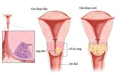 4 bước phát hiện sớm ung thư cổ tử cung