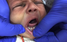 Chuyện lạ chưa từng thấy: Em bé mới chào đời đã "đầy một miệng răng"