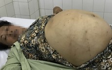 Người phụ nữ mang khối u buồng trứng gần 20 kg