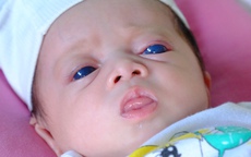 Từ trường hợp em bé sơ sinh có đôi mắt xanh biếc, sàng lọc trước sinh có phát hiện được không?