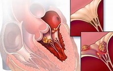 Dấu hiệu nhận biết sớm ung thư khoang miệng