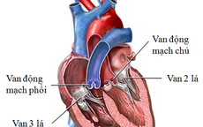 Nguyên nhân gây hở van tim