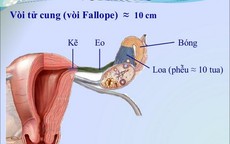Lần đầu chữa vô sinh do tắc vòi trứng bằng kỹ thuật nong nội soi