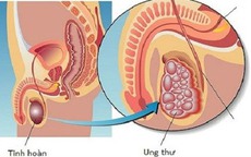 Chàng trai 25 tuổi mắc ung thư tinh hoàn và cảnh báo từ bác sĩ