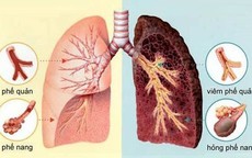 Những người có nguy cơ cao mắc bệnh phổi tắc nghẽn mạn tính