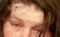 Bố mẹ nghiện ngập bỏ rơi, cô bé 15 ngày tuổi bị chuột cắn tới 100 nhát, tổn thương nặng ở vùng mặt