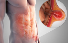 Sợ đau, người đàn ông U40 lấy dây buộc ngang, nâng khối thoát vị bẹn lên để khỏi phải mổ