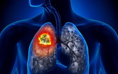Người đàn ông được phát hiện ung thư phổi sau 10 ngày ho khan, cảnh báo dấu hiệu sớm của bệnh phải cẩn trọng