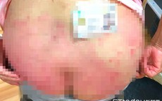 Người phụ nữ mắc bệnh vảy nến nghe lời khuyên tắm tinh dầu dưỡng da, sau 3 tháng hậu quả khôn lường