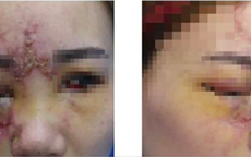 Cô gái trẻ mù mắt, mặt mũi biến dạng vì tiêm chất làm đầy mũi ở spa Đài Loan