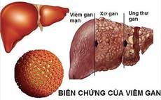 Viêm gan B lây lan nhanh hơn HIV gấp 100 lần, dùng chung bát đũa có lây?