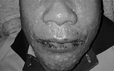 Người đàn ông trợt hết da, tổn thương sinh dục, phải cách ly dài ngày sau khi uống thuốc trị gout