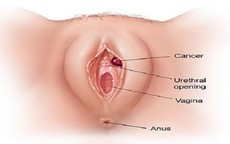 Người phụ nữ mắc ung thư, "vùng kín" chảy mủ ướt quần vì một hành động sai lầm