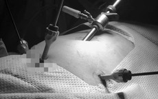 Cắt tử cung có khối u xơ to bằng thai 16 tuần cho bệnh nhân nữ ở TP HCM