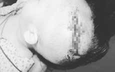 Bé trai 2 tuổi ở Hà Nội bị chó cắn lộ xương sọ