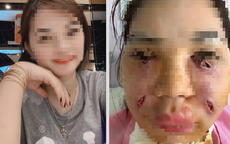 Rạch nhiều vết trên mặt để cứu cô gái trẻ ở Hà Nội tiêm mỡ tự thân làm đẹp