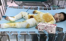 Xót xa bé trai 2 tuổi bị bỏng toàn thân do ngã vào nồi nước nóng