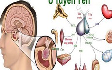 Dấu hiệu bị u tuyến yên, nhiều người có mà không biết