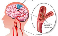 Sai lầm nhiều người mắc khi sơ cứu người bị đột quỵ khiến bệnh trầm trọng hơn