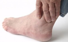 Dấu hiệu của bệnh gout