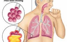 Đón Tết đừng quên phòng chống bệnh viêm phổi cấp lây truyền từ Vũ Hán, Trung Quốc