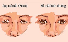 Điều trị sụp mí bằng Đông y – trẻ hóa cơ mắt, cải thiện tầm nhìn