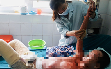 Bình ga mini phát nổ, cháu bé ở Hà Tĩnh bị bỏng 71% mà không có tiền chữa trị