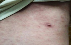 Nghệ An: Nhiều người nhập viện vì bệnh "sốt mò"