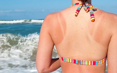 Áp dụng 5 cách chăm sóc da bị cháy nắng đơn giản giúp da lên tông nhanh chóng