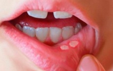 Viêm loét khoang miệng, nhiệt miệng, nhiệt lưỡi, nhiệt lợi chữa mãi không khỏi - xem ngay nguyên nhân và biện pháp khắc phục hiệu quả