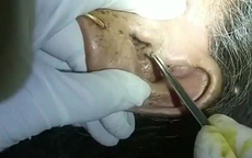 Lạnh người cảnh bác sĩ gắp 30 con giòi trong tai bệnh nhân