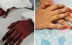 Cô gái được ghép tay từ nam thanh niên da đen, 2 năm sau điều kỳ diệu bỗng xảy ra