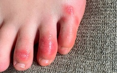 "Ngón chân COVID" và những biểu hiện trên da có thể là dấu hiệu mắc COVID-19