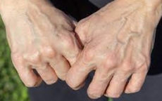 Giãn tĩnh mạch bàn tay có khó trị?