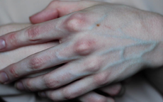 Có 4 dấu hiệu này xuất hiện trên bàn tay, cảnh báo mạch máu bị tắc nghẽn
