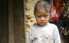 Mắt ngày càng lồi to, cậu bé dân tộc H'Mông nguy cơ bị mù vì không có tiền đi khám mắt