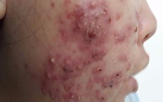 Tưởng mụn trứng cá hoá ra bệnh lần đầu nghe đến, thời gian chữa trị rất dài