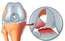 Không tập thể dục, không chơi thể thao, nhưng nhóm phụ nữ này lại dễ bị rách dây chằng đầu gối gấp 8 lần nam giới