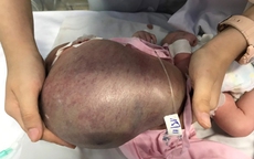 Bé trai vừa chào đời đã bị khối bứu hiếm gặp, to gần bằng cơ thể chèn đường thở
